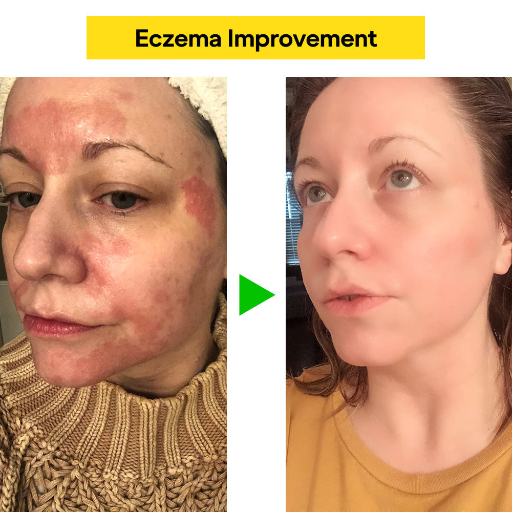 East Asia Eczema & Psoriasis Natural Herbal Cream